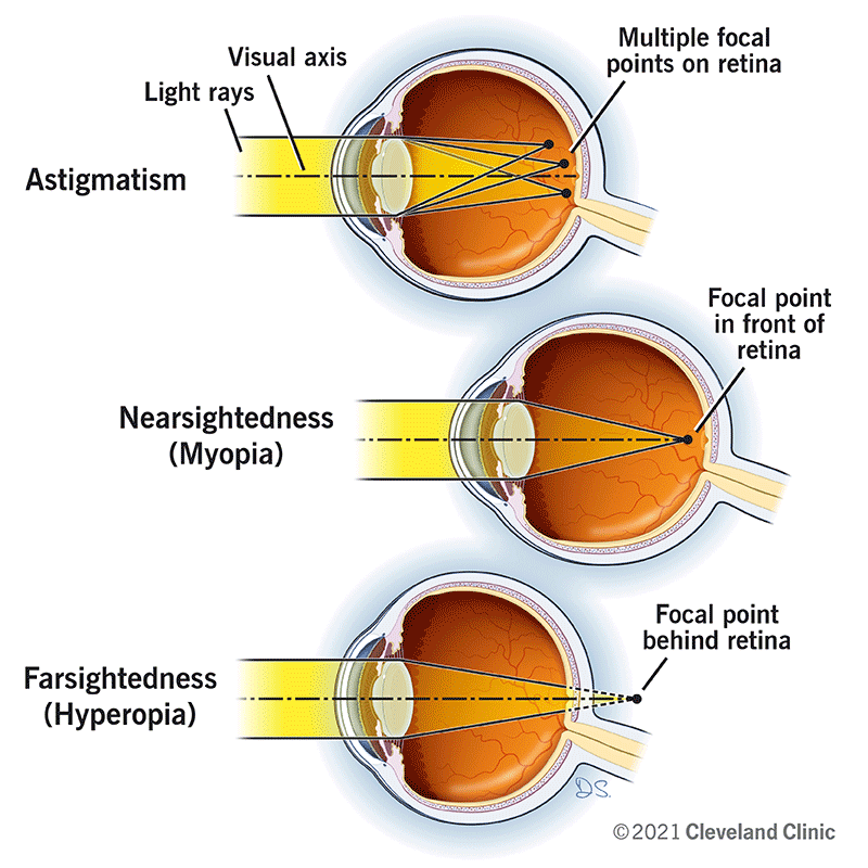 在散光、近视和远视中，视轴和光线在眼睛视网膜上、后面和前面形成不同的焦点。