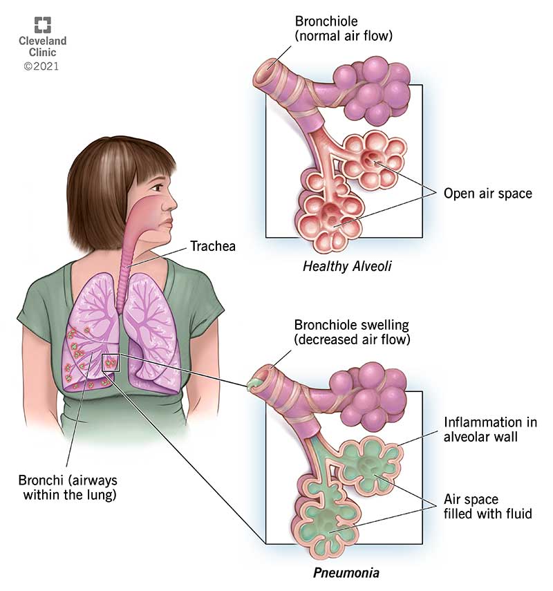 图示健康肺泡和肺细支气管。