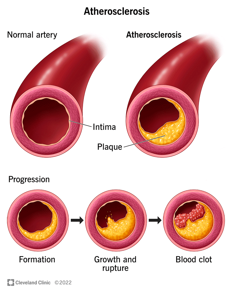 动脉粥样硬化从早期斑块形成发展到斑块生长。最后，斑块破裂并引发血块。