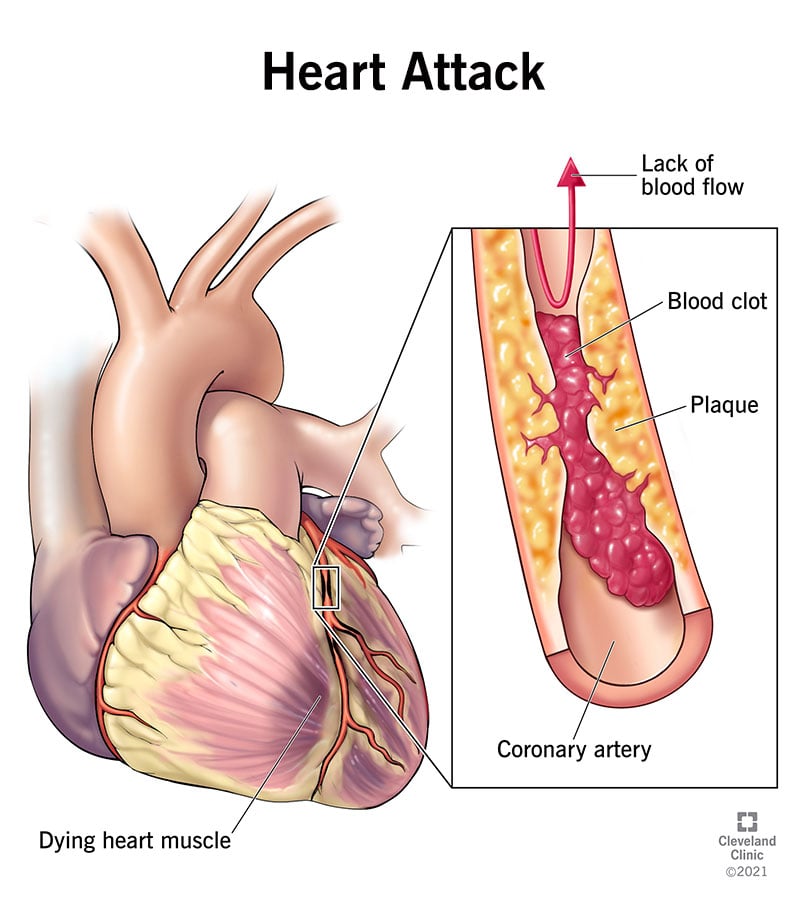 冠状动脉堵塞使血液无法到达心肌，导致心脏病发作。