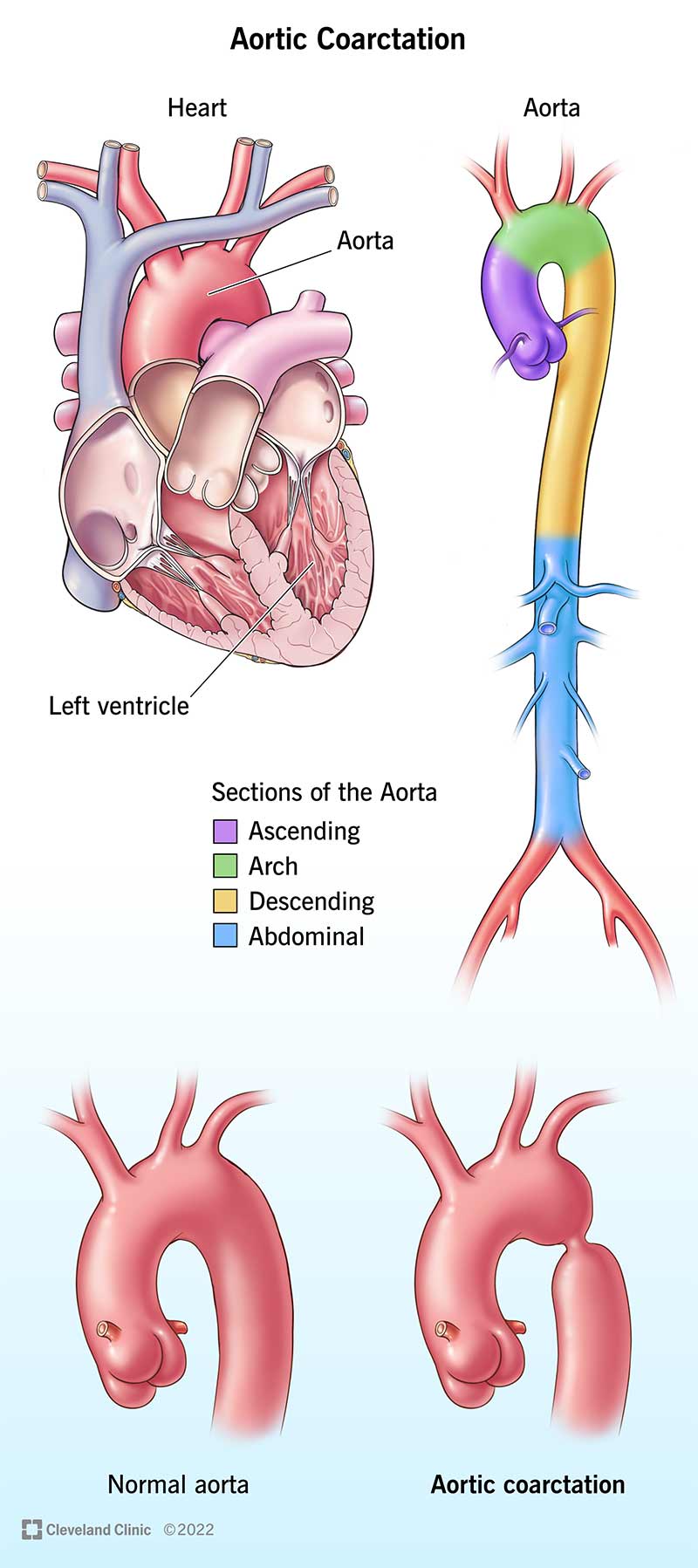 一群插图显示心脏的解剖和主动脉。并排图片显示主动脉与健康的缩小。