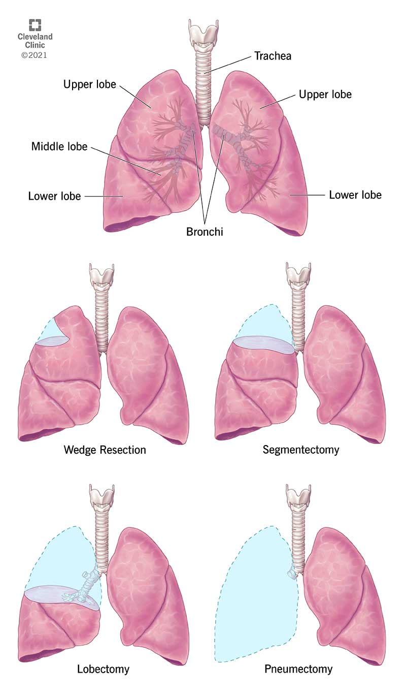 肺的图示，以及不同类型肺切除术的举例说明。