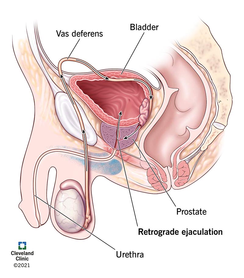 男性生殖系统的医学插图，显示由于逆行射精导致精液进入膀胱的路径