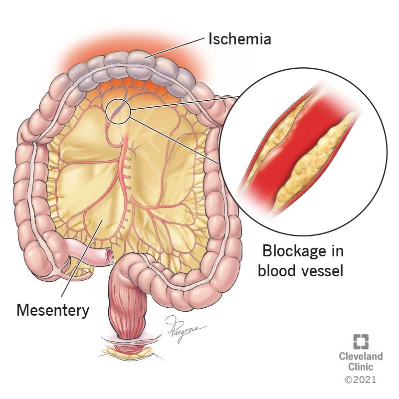 肠系膜动脉狭窄和阻塞会导致缺血，使消化道失去重要的血液和氧气。