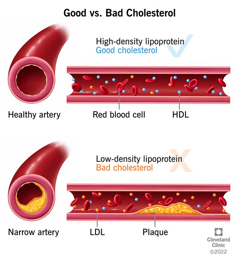健康动脉和狭窄动脉的对比图坏胆固醇(低密度脂蛋白)有助于狭窄动脉斑块的形成。