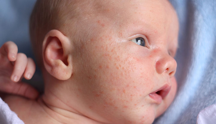 婴儿痤疮会导致宝宝脸上出现白色的小肿块和粉红色的丘疹。