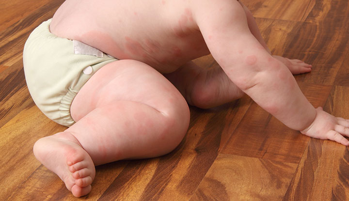 孩子胸部出现粉红色和红色的荨麻疹。
