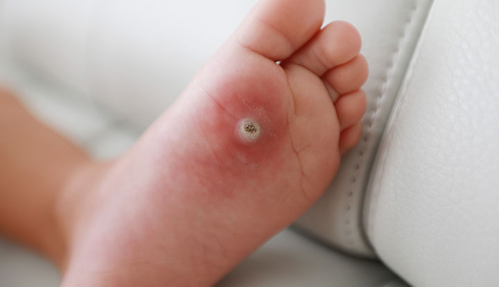 孩子身上的疣是一种由HPV引起的皮肤感染。这种感染会在孩子的皮肤上形成坚硬的肿块。