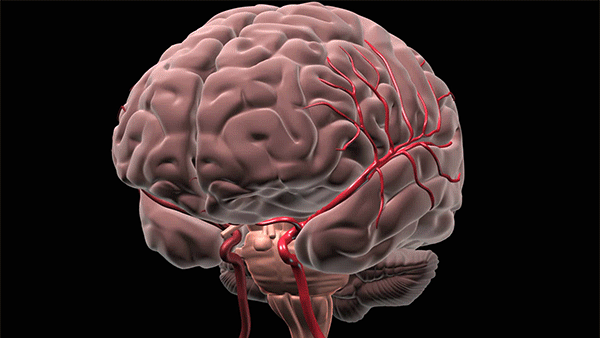 脑深部出血通常发生在小血管破裂，血液进入脑组织时。高血压是这些小血管破裂的最常见原因。(资料来源:克利夫兰诊所)