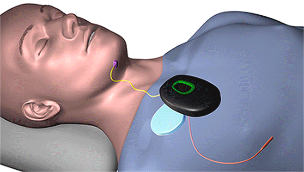 通过遥控器，这种植入式设备可以同步舌头和上颚的运动，从而在整个晚上打开关键的气道肌肉。(资料来源:克利夫兰诊所)