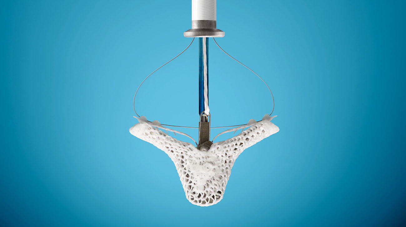 经导管二尖瓣修复装置用于治疗二尖瓣反流，无需侵入性手术。(礼貌:Abbott)
