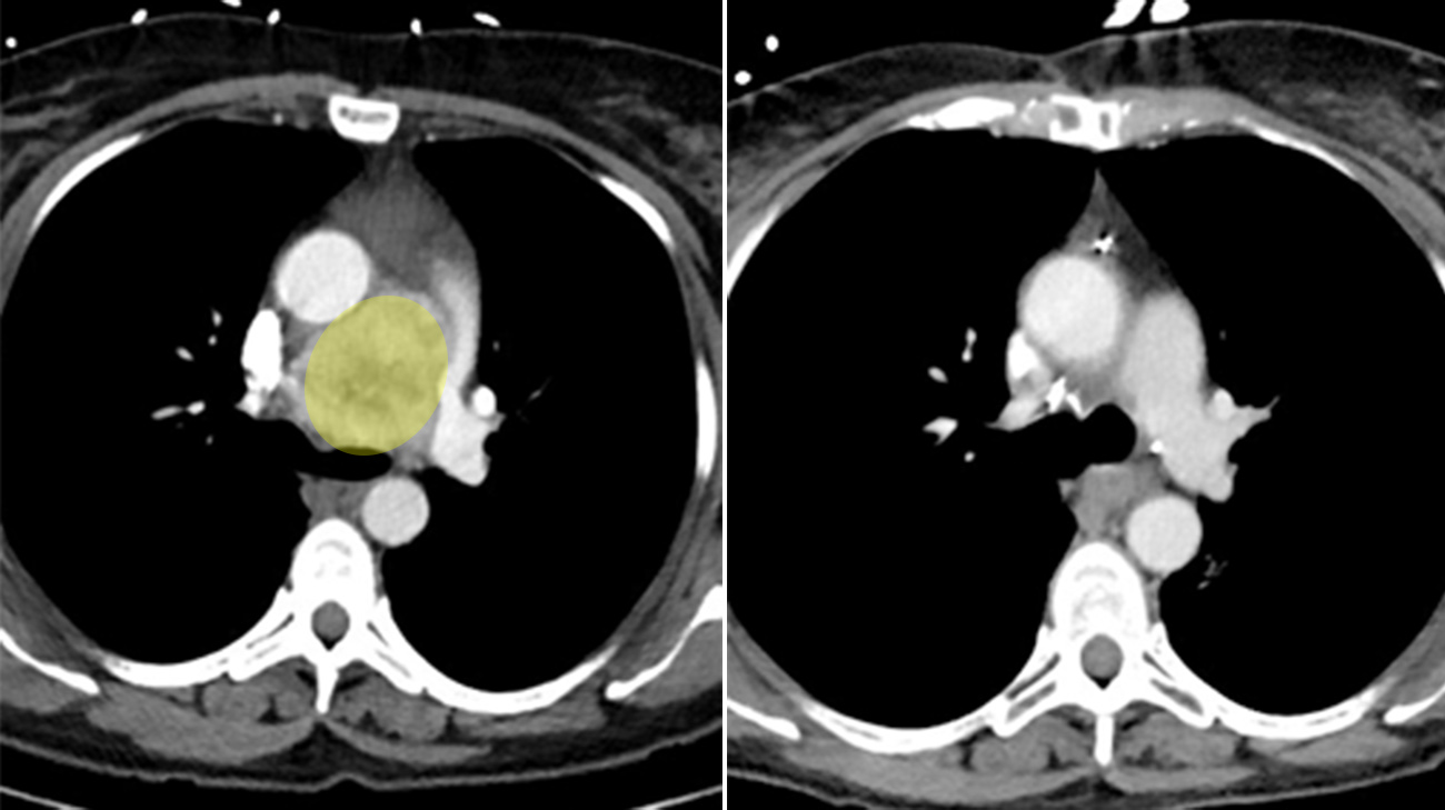 放射治疗前肿瘤大小为网球(左)。尽管治疗缩小了肿瘤(右)，医生仍然需要完成手术。(由克利夫兰诊所提供)