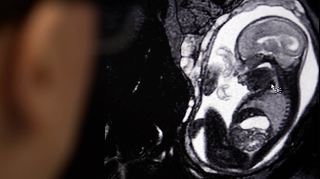 脊柱裂胎儿的MRI。