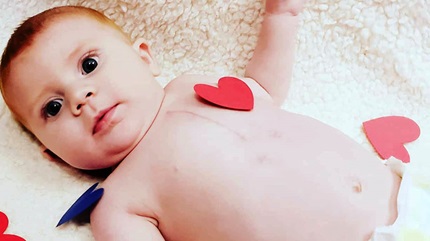 卡森出生时患有先天性心脏缺陷，称为主动脉狭窄。