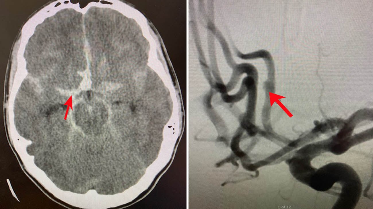 罗比大脑的CT扫描显示他的蛛网膜下腔出血就在中间的白色区域。脑血管造影显示他的动脉瘤。