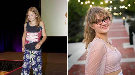 左图:戴着夜间支架的年轻安娜。右:安娜术后