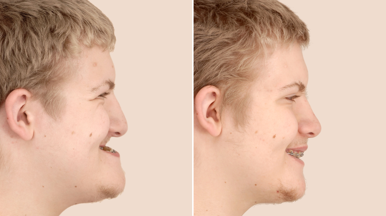 前后对比:杰克出生时就有严重的下牙，他接受了手术，重新定位了他的上颚和下颚，并在脸颊上植入了植入物。