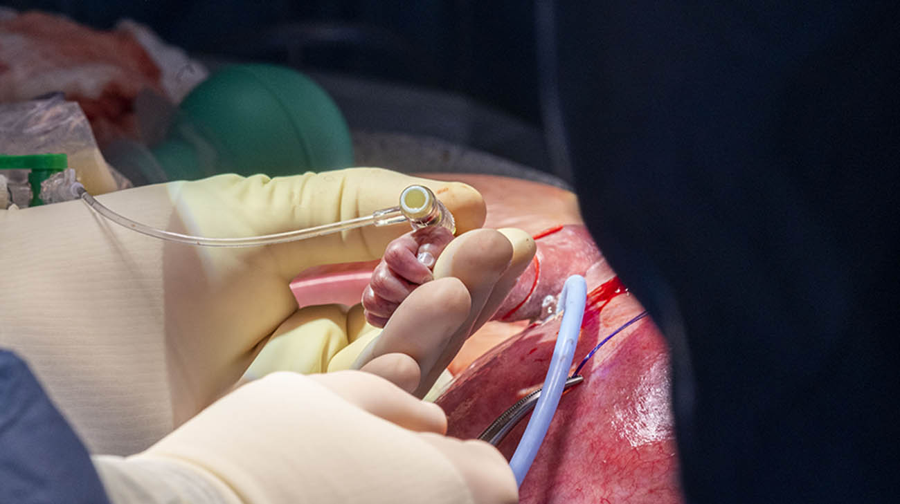 心脏外科团队的负责人哈尼·纳杰姆(Hani Najm)医生在胎儿的右臂插入静脉输液管，以便根据需要输送液体和药物。