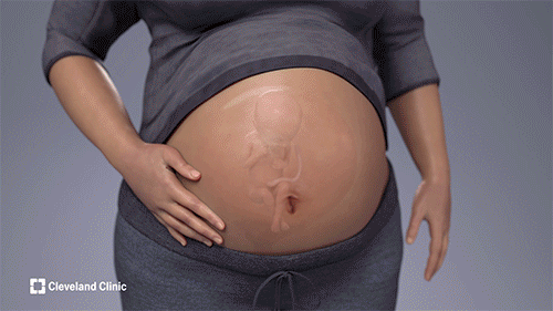 外科医生如何从一个26周大的胎儿身上切除心包内畸胎瘤的动画。