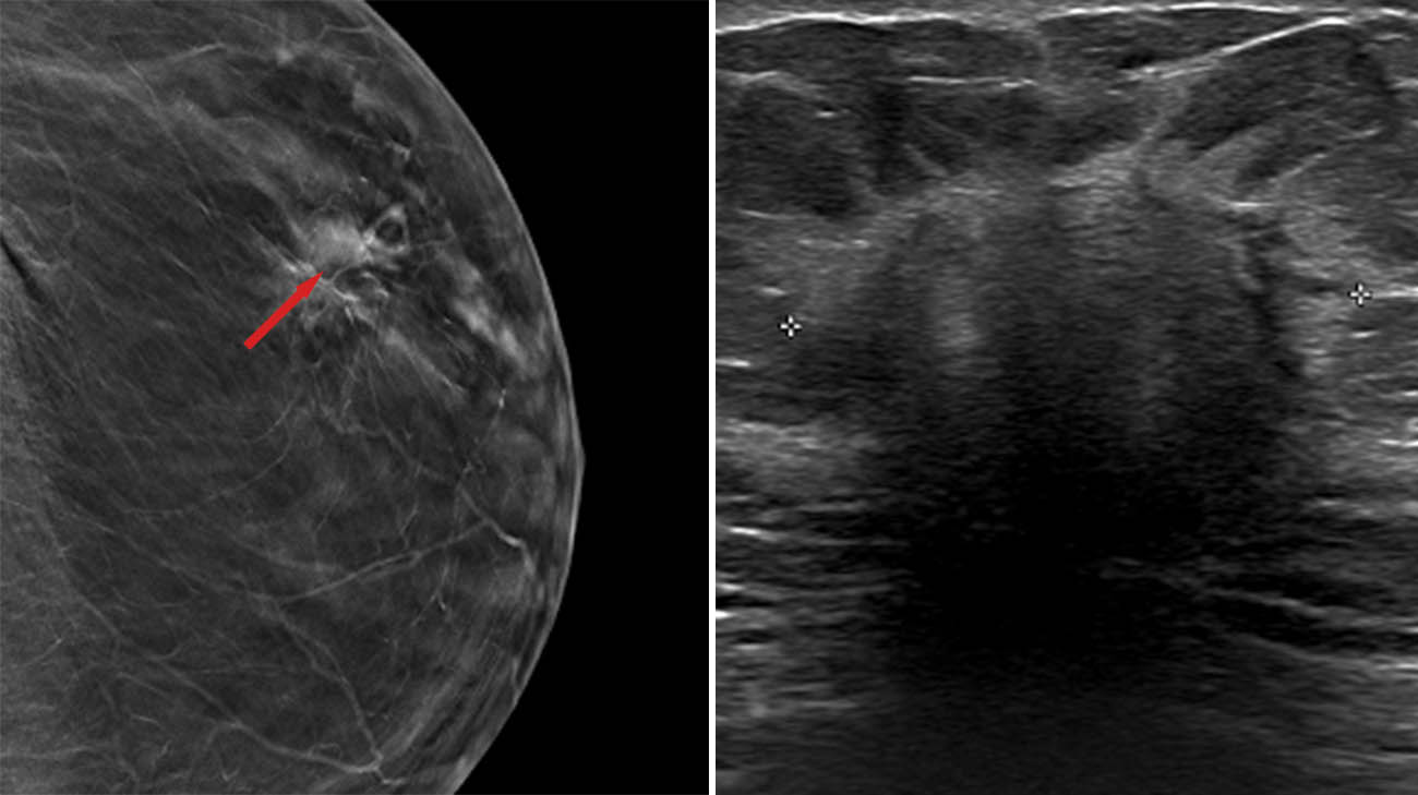 维吉乳腺癌的乳房x光和超声波检查。