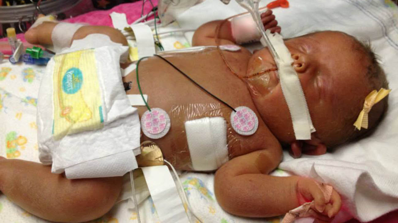 雅各布是克利夫兰诊所新生儿重症监护室中病情最严重的婴儿之一。
