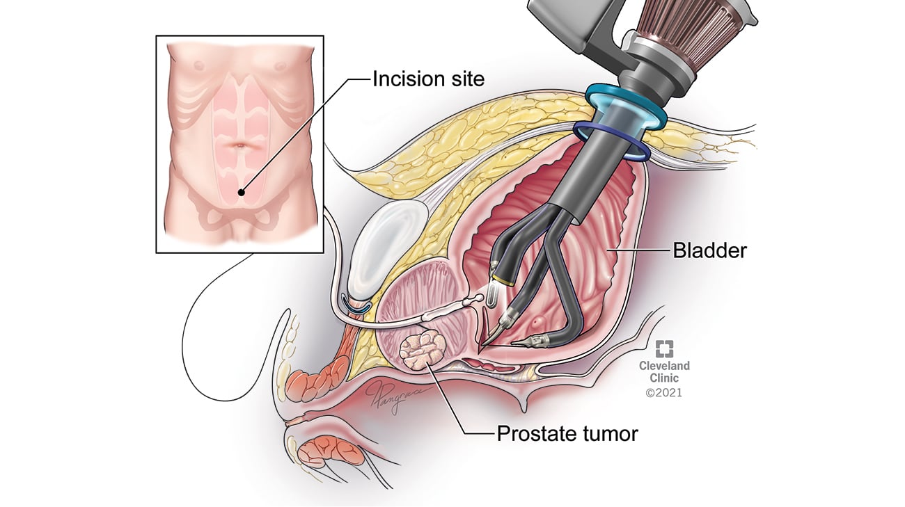 克利夫兰诊所单臂机器人膀胱前列腺切除术。