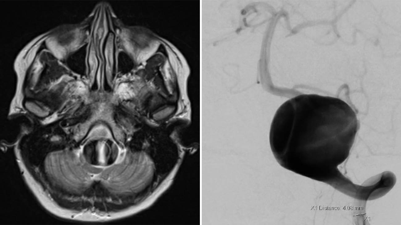 马洛里脑动脉瘤的脑部扫描图。
