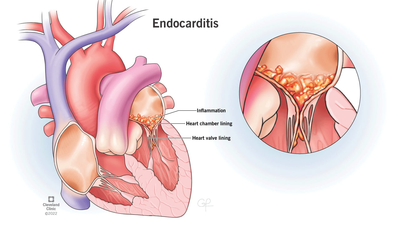 心内膜炎是一种心脏瓣膜和心室的炎症。