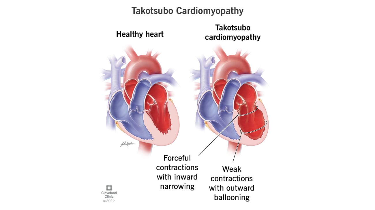 克利夫兰诊所的takotsubo心肌病或心碎综合征说明。