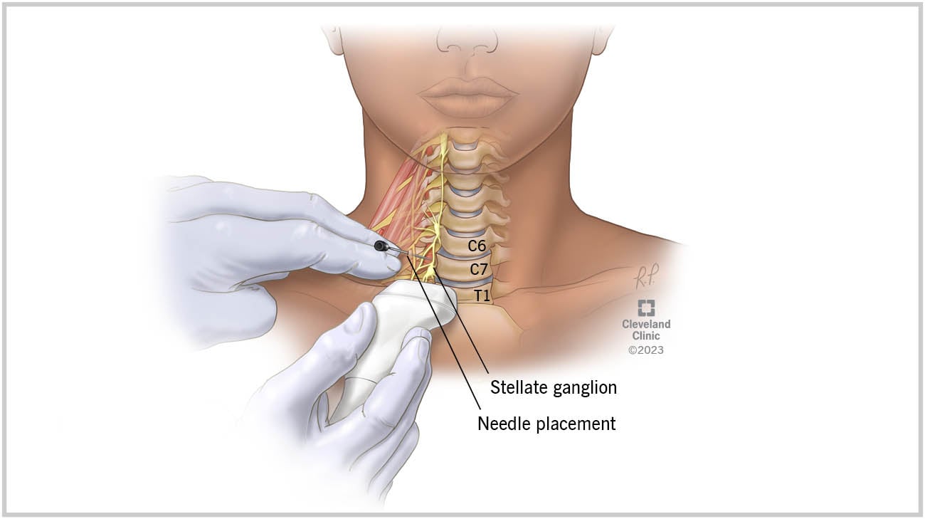 星形神经节阻滞是将药物注射到颈部前方底部的神经集合中。