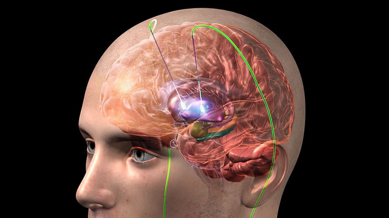 在深度脑刺激中，电极被植入大脑，它传递电脉冲，阻止或改变导致症状的异常活动。(克利夫兰诊所提供)